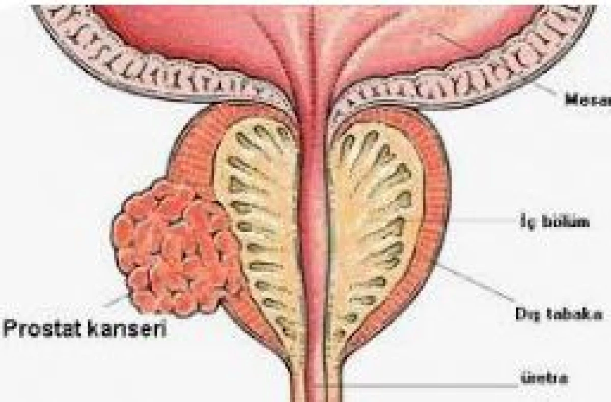                      50 yaş &uuml;st&uuml; her erkek bu testi yaptırmalı! 
